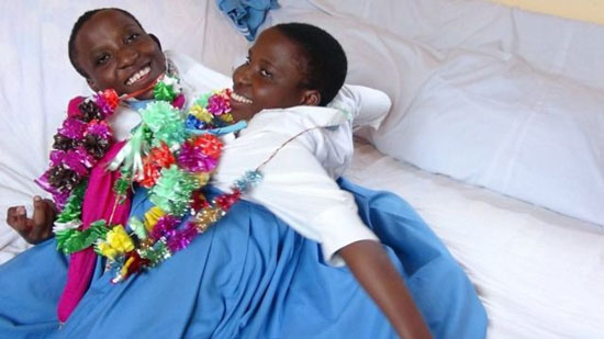 وفاة التوأم الملتصق بتنزانيا