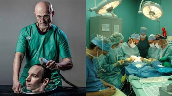 أطباء يستعدون لأول عملية زرع رأس إنسان
