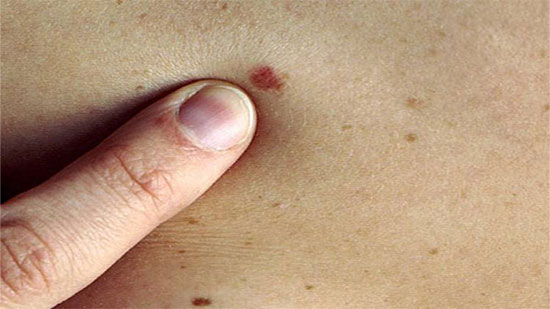  7 أعراض تنذر بالإصابة بسرطان الجلد 