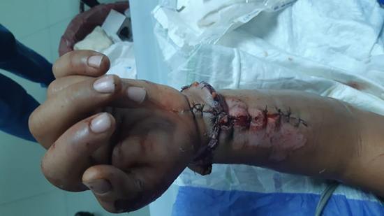  زرع يد شاب بعد بترها بالكامل فى حادث سيارة بمستشفي جامعة أسيوط