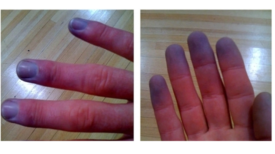 يسبب تغير لون الأصابع في الشتاء.. نصائح للوقاية من مرض 