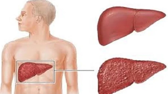 أعراض وأسباب والوقاية من التهاب الكبد الوبائي