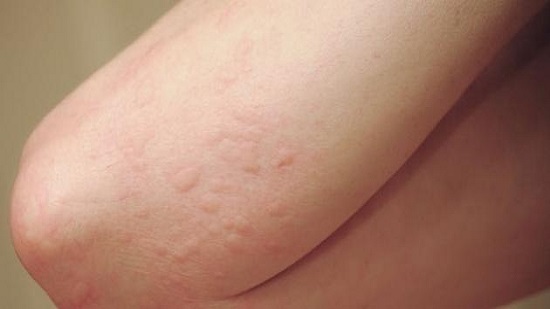 دراسة بريطانية صادمة: الطفح الجلدى أحد أعراض الإصابة بفيروس كورونا