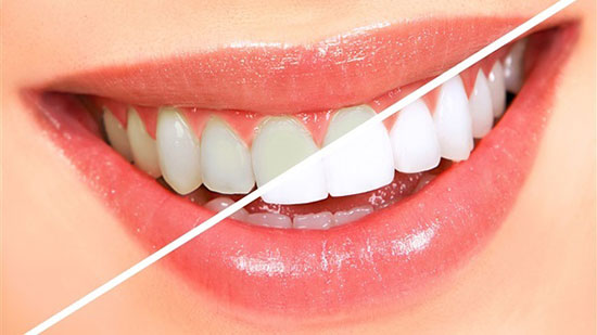 علاجات منزلية للتخلص من اصفرار الأسنان