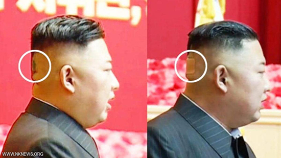 ضمادة وبقعة غريبة.. رأس زعيم كوريا الشمالية يثير التساؤلات
