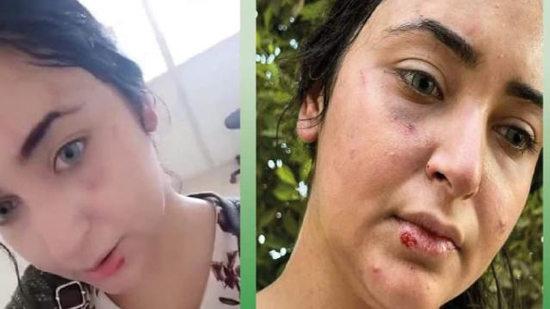 الاعتداء على طبيبة بالزقازيق وإصابتها لعدم ارتداء الحجاب والضحية تستغيث 