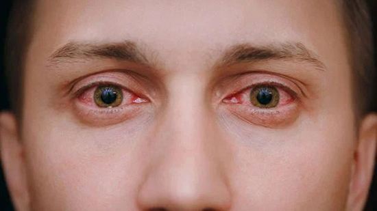 التهابات وردية في العين