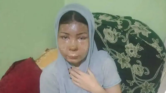 فتاة رفضت الزواج فحرق وجهها بماء نار