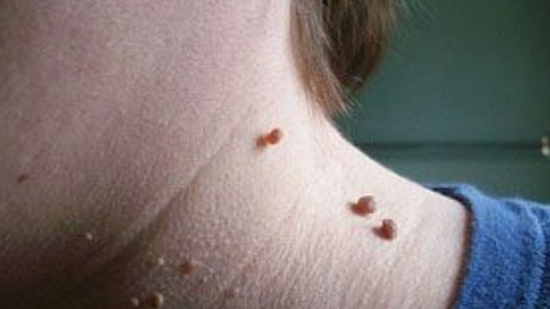 أسباب الزوائد الجلدية وعلاجها في أي منطقة بالجسم